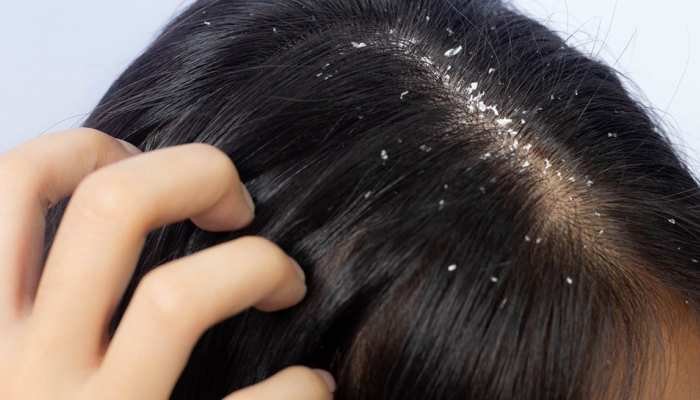 Anti-Dandruff Treatment